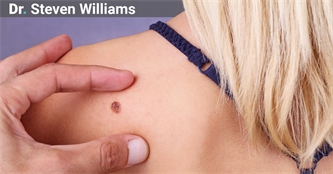 When Moles Become Dangerous: 4 Warning Signs