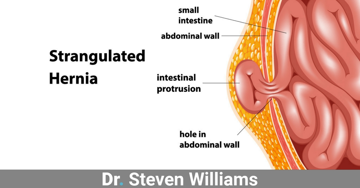 When It's Time For Hernia Surgery